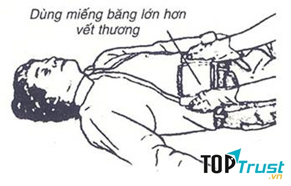 Khi ruột bị lòi ra ngoài