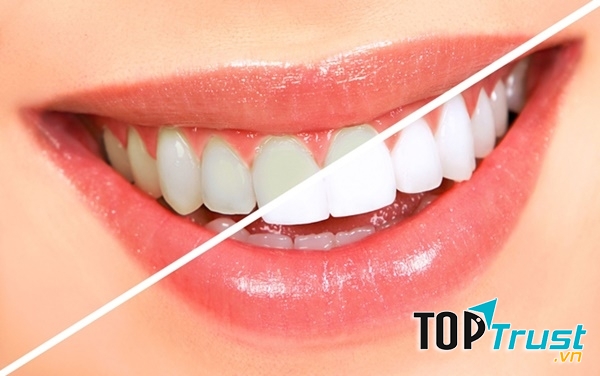 Hàm răng trắng sáng giúp bạn có nụ cười rạng rỡ, tự tin