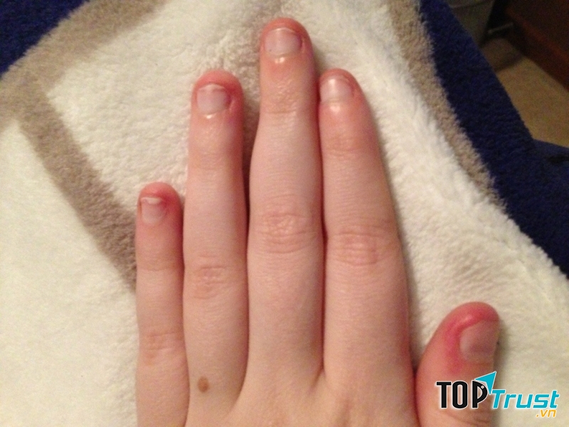 Cắn móng tay khiến móng tay của bạn bị tổn thương và xấu xí