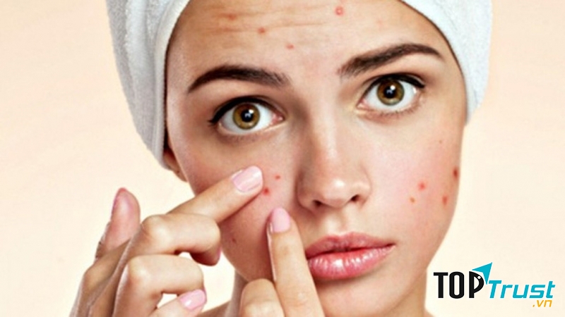 Nặn mụn gây tổn thương da và làm tình trạng mụn nghiêm trọng hơn