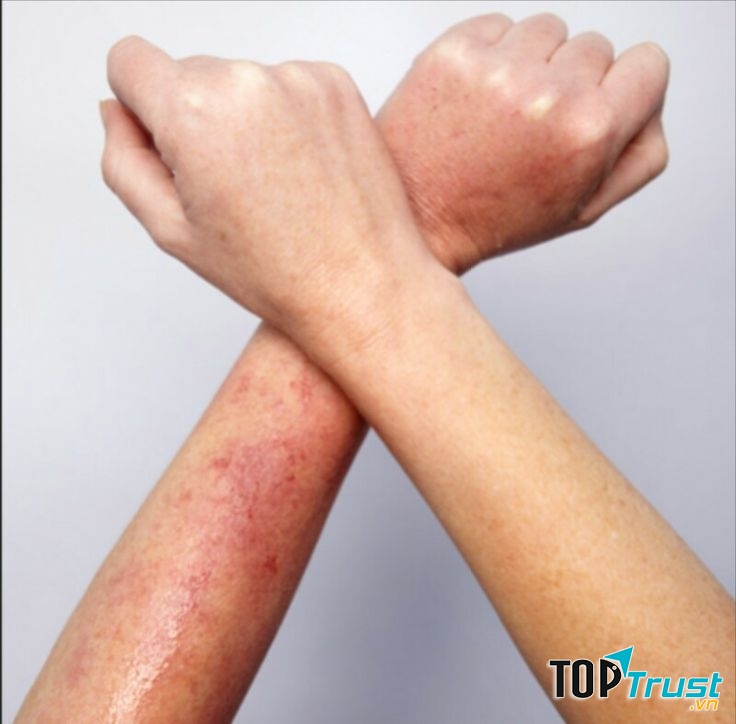 Hãy chú ý những vết ửng đỏ, ngứa ngáy hay châm chích không giảm sau khi waxing