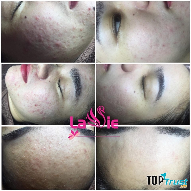 Hình ảnh thật của khách hàng tại La vie Spa