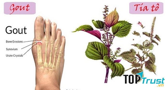 Tía tô với bệnh gút (gout)