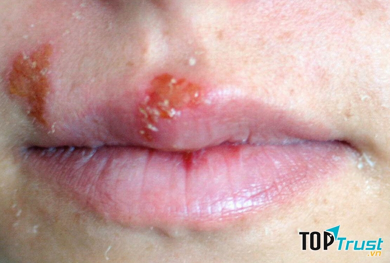 Lạm dụng son môi