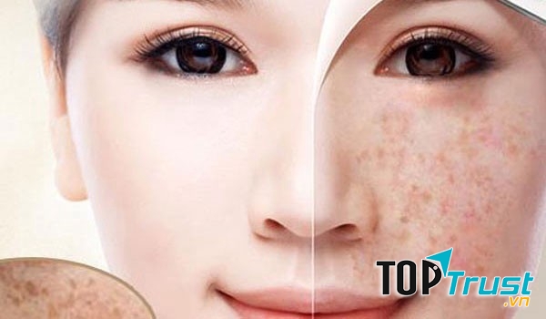 Dầu thầu dầu làm mờ các đốm đồi mồi hiệu quả