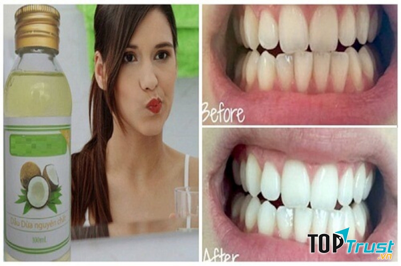 Làm trắng và ngừa sâu răng