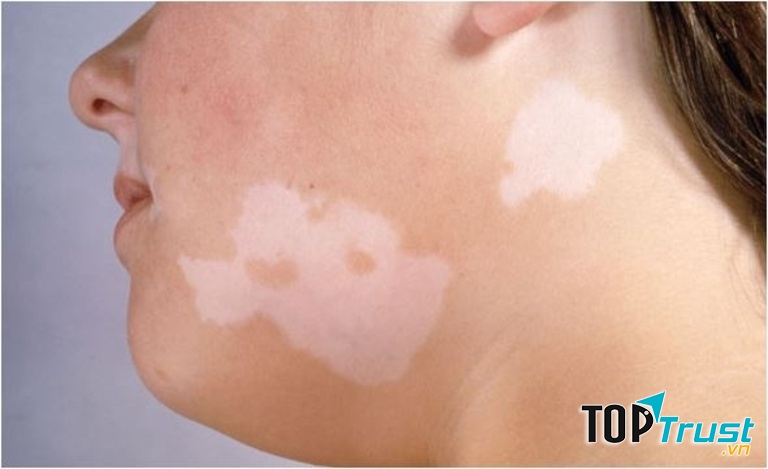 Bệnh lang ben có biểu hiện là trên bề mặt da người bệnh có vẩy mịn. Vị trí thường bị bệnh là vùng cổ, ngực, mặt, lưng, đùi,...