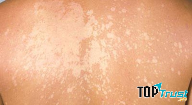 Lang ben là một căn bệnh ngoài da do vi khuẩn nấm gây nên.