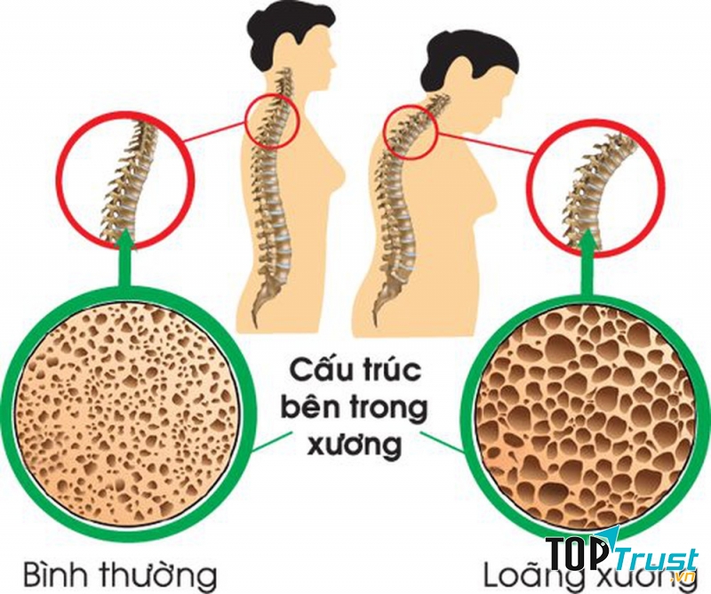 Loãng xương làm hỏng xương hàm, xương ổ răng