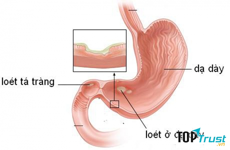 Loét dạ dày