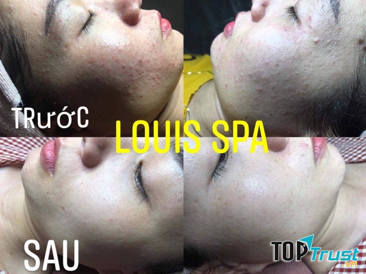 LOUIS SPA QUẢNG NGÃI - Viện Thẩm Mỹ Công Nghệ Cao