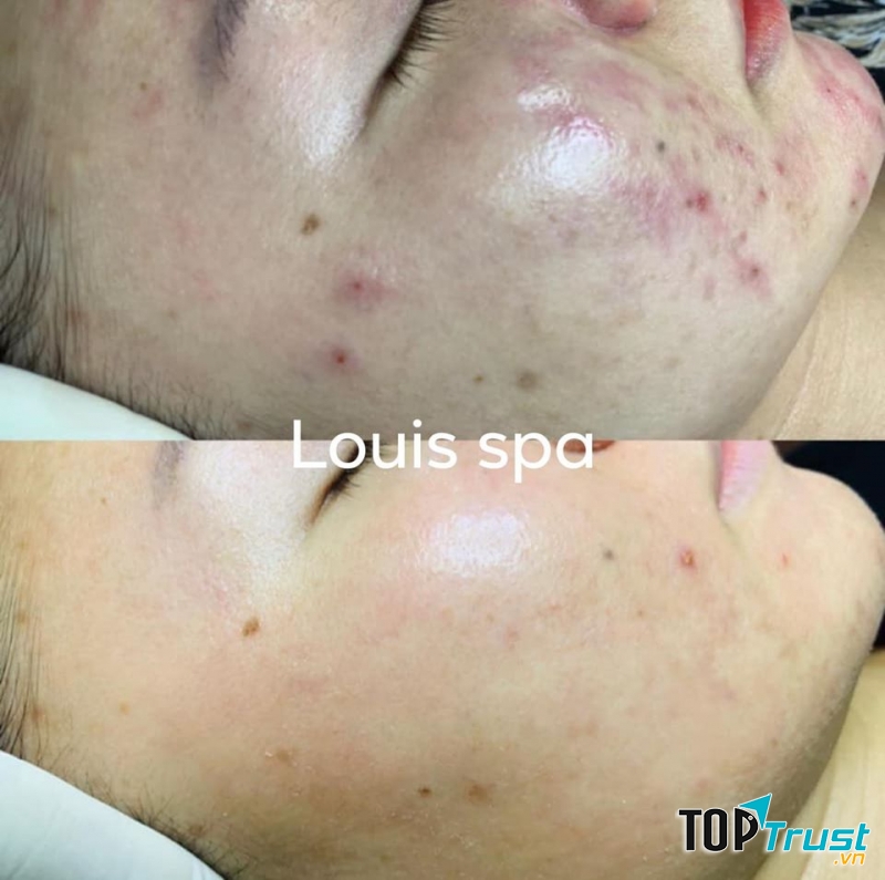 LOUIS SPA QUẢNG NGÃI - Viện Thẩm Mỹ Công Nghệ Cao