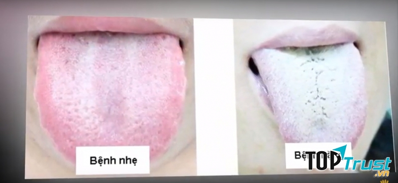 Lưỡi bóng loáng, trắng và bị khô