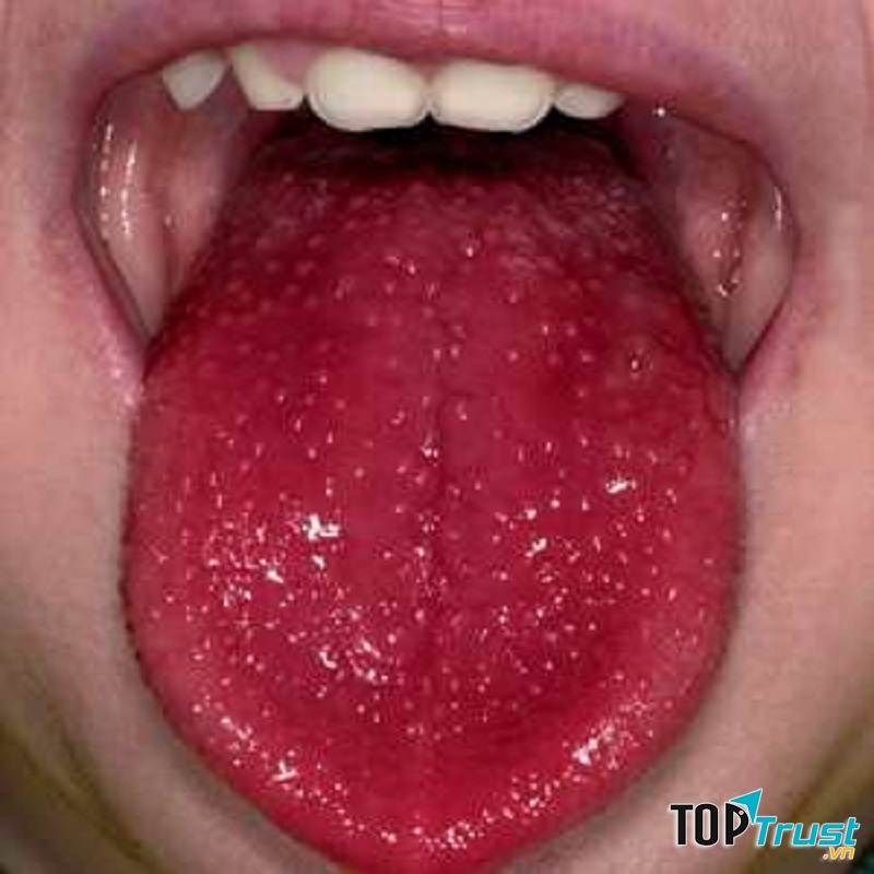 Triệu chứng này thường gặp nhất ở trẻ em