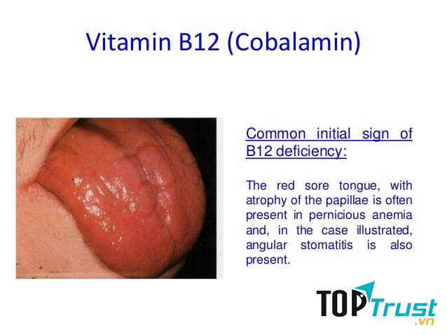 Bạn cũng nên chú ý nếu bề mặt lưỡi quá mịn và có màu đỏ nhé