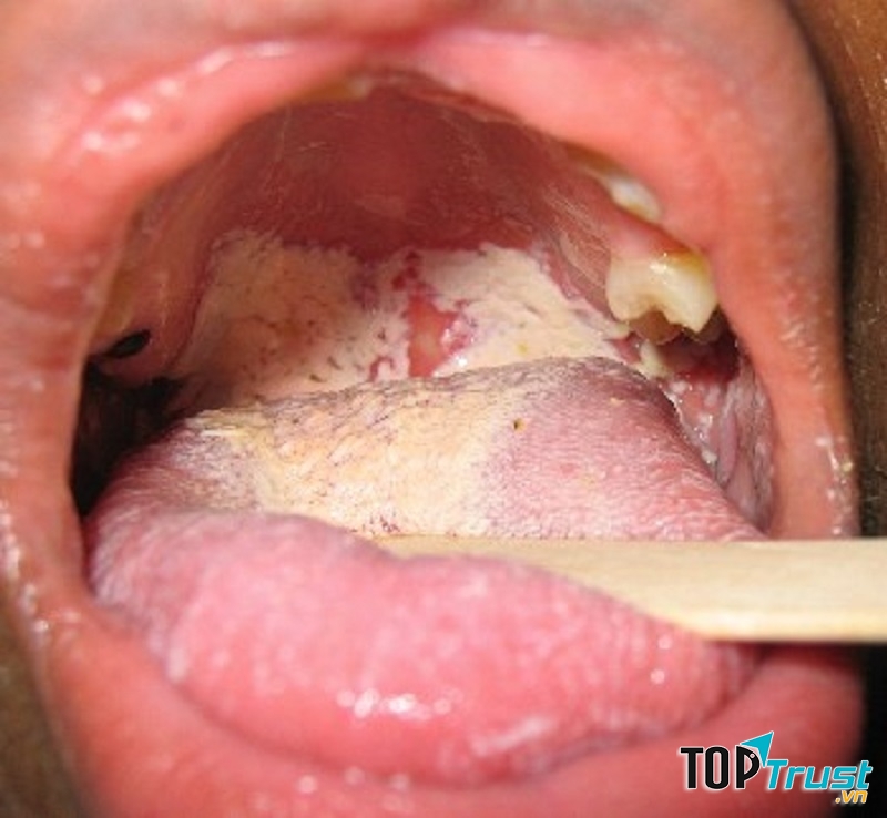 Lưỡi xuất hiện các khoảng màu trắng là dấu hiệu cho thấy bạn đang bị bệnh