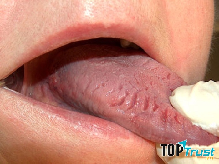 Khi tuổi tác càng cao sẽ xuất hiện tình trạng lão hóa diễn ra trong cơ thể khiến lưỡi bị ảnh hưởng