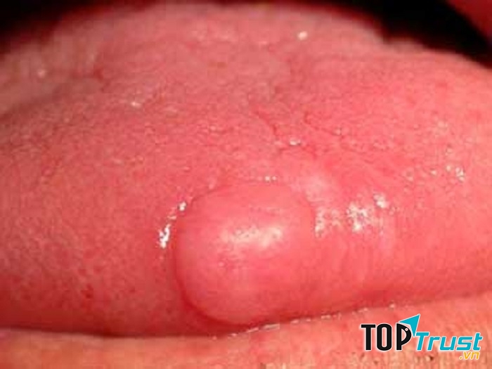 Triệu chứng này rất dễ bị nhầm với nhiệt miệng