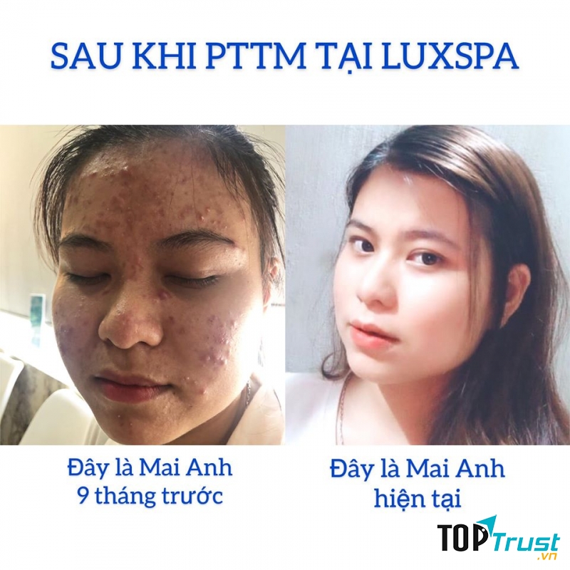 LuxSpa - Chuyên điều trị Mụn, Thâm, Sẹo