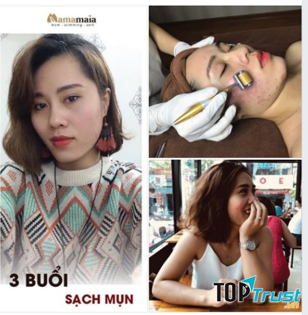 Da sạch mụn, hạn chế sẹo thâm, bật tone trắng sáng của khách hàng khi chăm sóc tại Mama Maia Spa