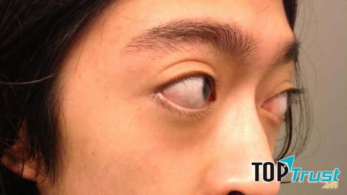 mắt lồi to cũng là một dấu hiệu cho thấy bạn đang mắc bệnh Graves