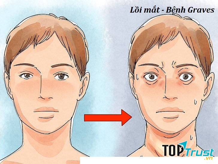 mắt lồi to cũng là một dấu hiệu cho thấy bạn đang mắc bệnh Graves