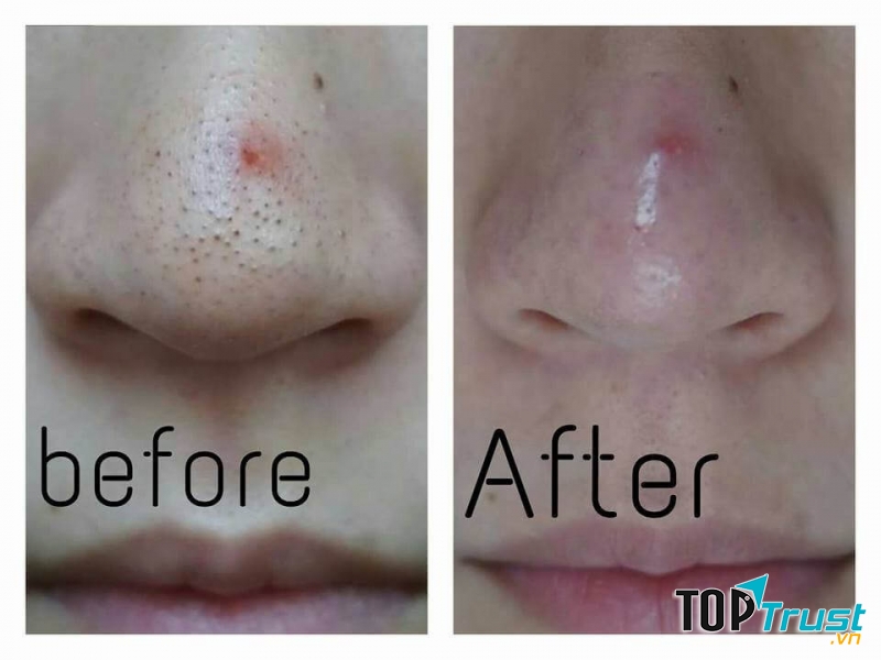 Trước và sau khi sử dụng Mặt nạ than lột mụn Mistine Blackhead Carbon Peel Off Mask