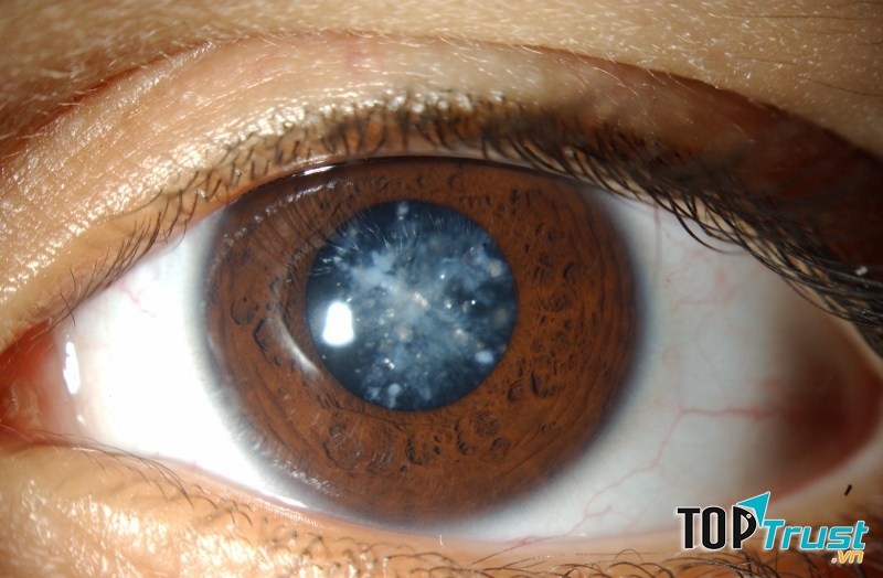 Mắt nhìn thấy các đốm, vệt báo hiệu nhiều bệnh nguy hiểm liên quan đến mắt