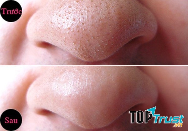 ﻿Hiệu quả khi sửa dụng Máy Hút Mụn Cám Panasonic EH2513P