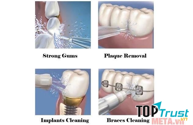 Sản phẩm còn đặc biệt phù hợp với việc vệ sinh những chiếc răng giả, đang niềng răng, cấy ghép răng bởi áp lực tia nước, những chiếc răng sẽ được thoải mái tắm mát bằng làn nước trong lành