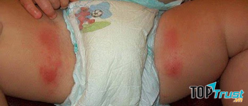 Mẹo vặt chữa hăm cho bé