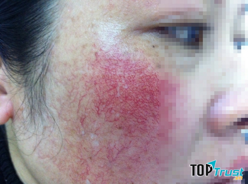 Tác hại do Thủy Ngân gây ra