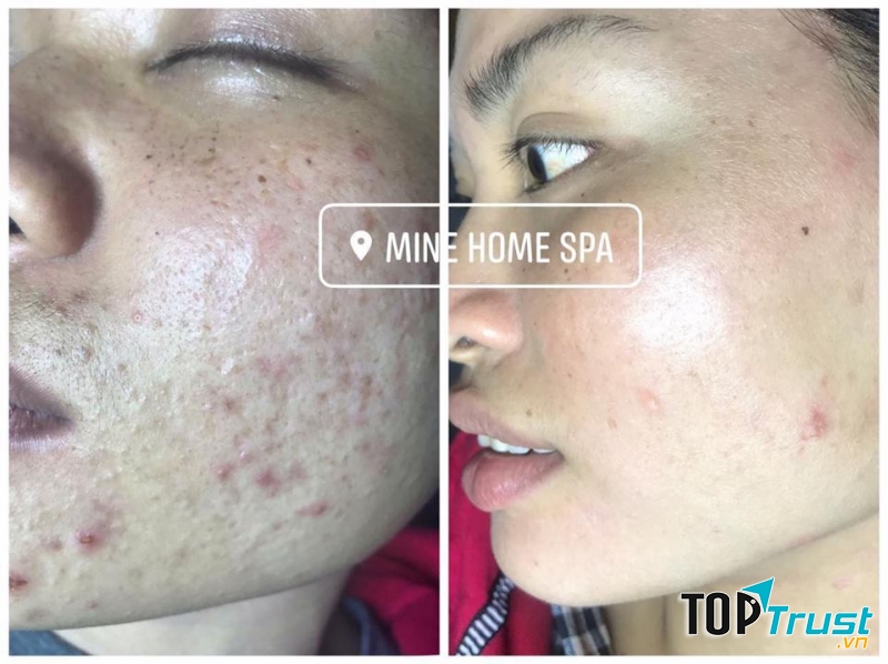 Mine Home Spa - Trị mụn