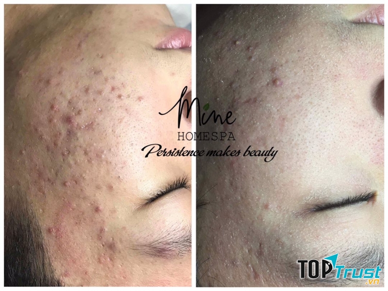 Mine Home Spa - Trị mụn