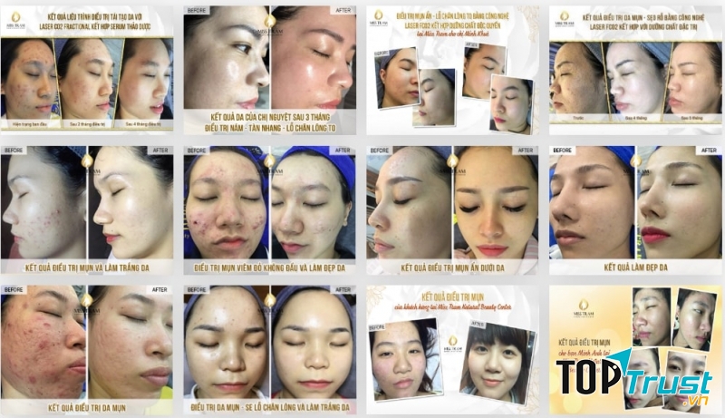 Miss Trâm Spa – Nơi chuyên trị lấy nhân mụn hơn 15 năm kinh nghiệm ở HCM