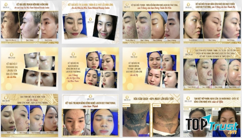 Miss Trâm Spa – Nơi chuyên trị lấy nhân mụn hơn 15 năm kinh nghiệm ở HCM