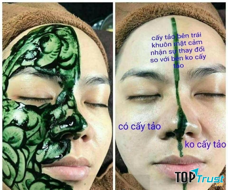 Khách hàng sử dụng dịch vụ cấy tảo biển tại Mộc Spa