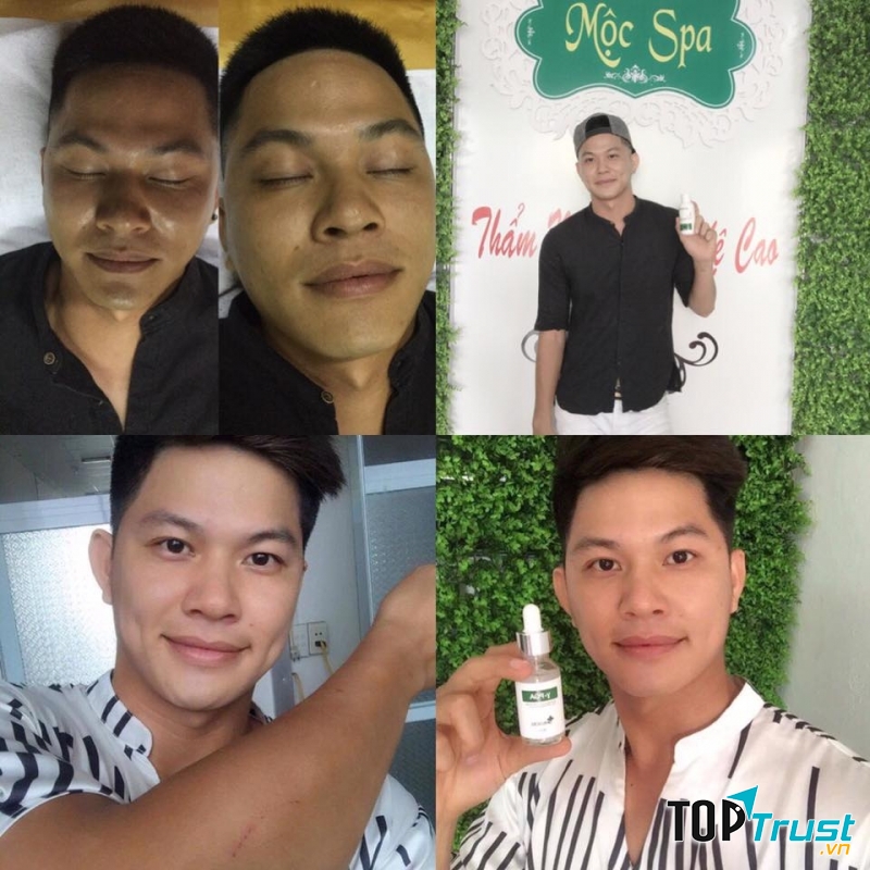 Khách hàng sử dụng dịch vụ vi kim tảo biển và mỹ phẩm hỗ trợ điều trị Đông Y Phúc Sinh tại Mộc Spa