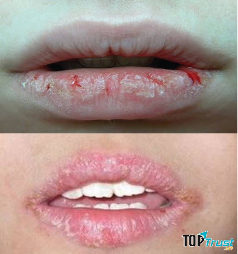 Môi khô nứt nẻ, dấu hiệu thiếu vitamin B12