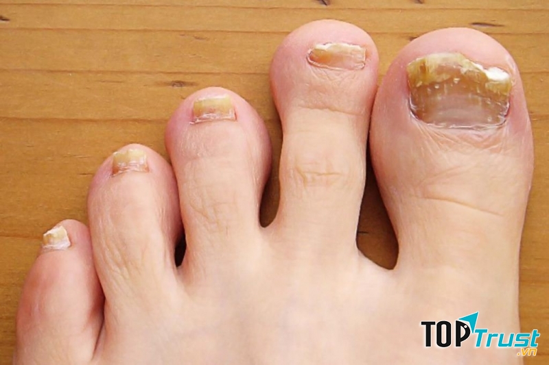 Móng chân trở nên vàng