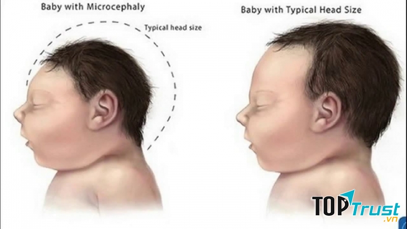 Muỗi lây truyền virus Zika gây hiện tượng đầu nhỏ ở trẻ - Nguồn Internet