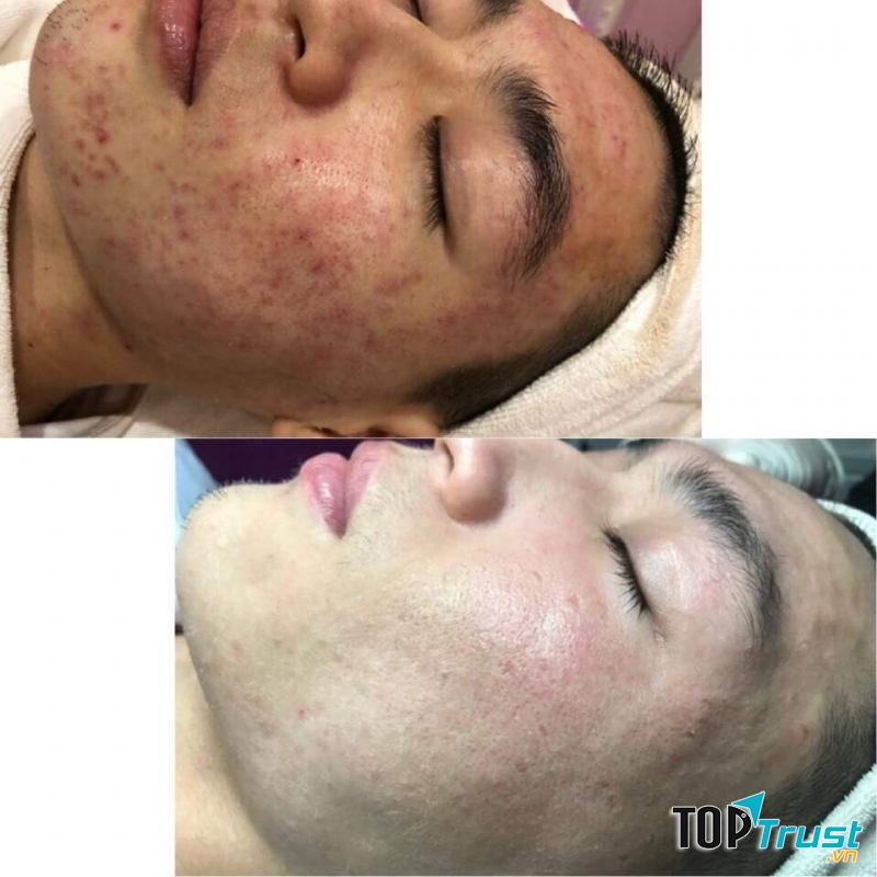 Một khách hàng chữa trị tại Nàng Spa.