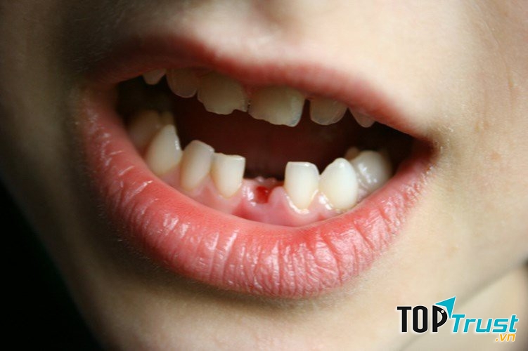 Trẻ nhỏ thường có nhiều thói quen xấu: đẩy lưỡi, mút tay, ngậm ti giả, cắn ngón tay hoặc chống cằm...