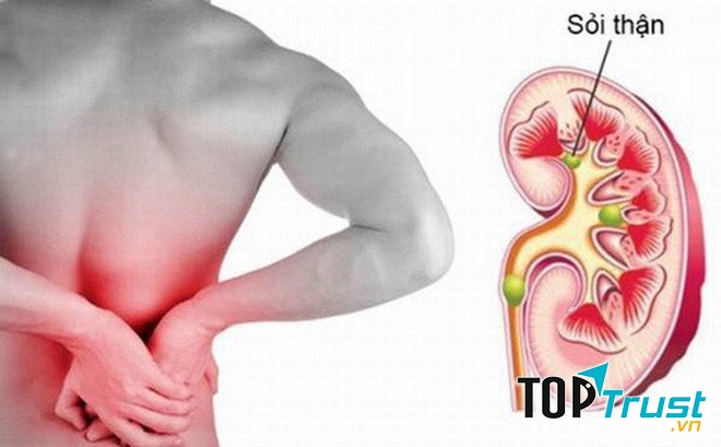 Ngăn ngừa sỏi thận và nhiễm trùng bàng quang