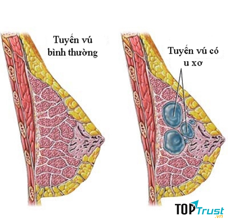 Nuôi con bằng sữa mẹ giúp ngăn ngừa ung thư vú.