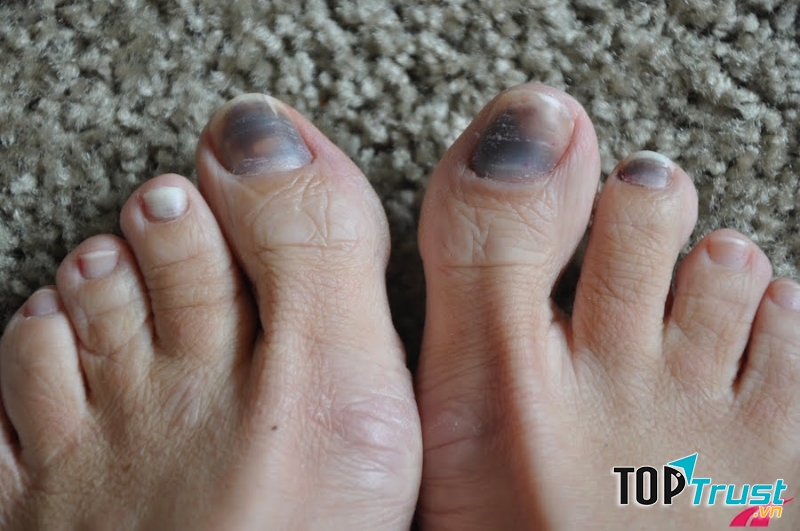 Ngón cái ở bàn chân phình to