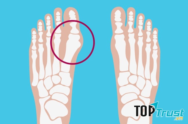 Ngón chân bị biến dạng