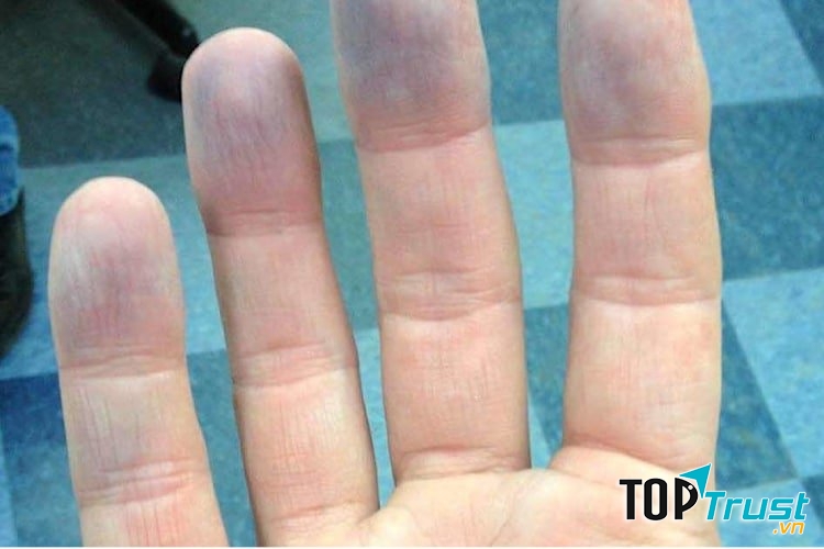 Ngón tay đổi màu (tím tái)