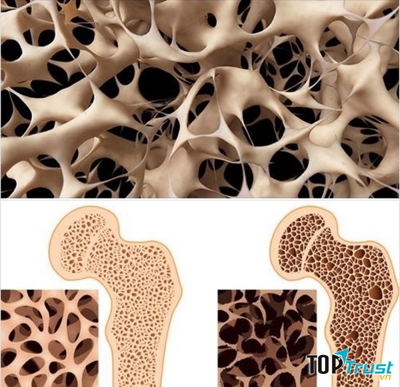 Loãng xương từ nước ngọt có gas