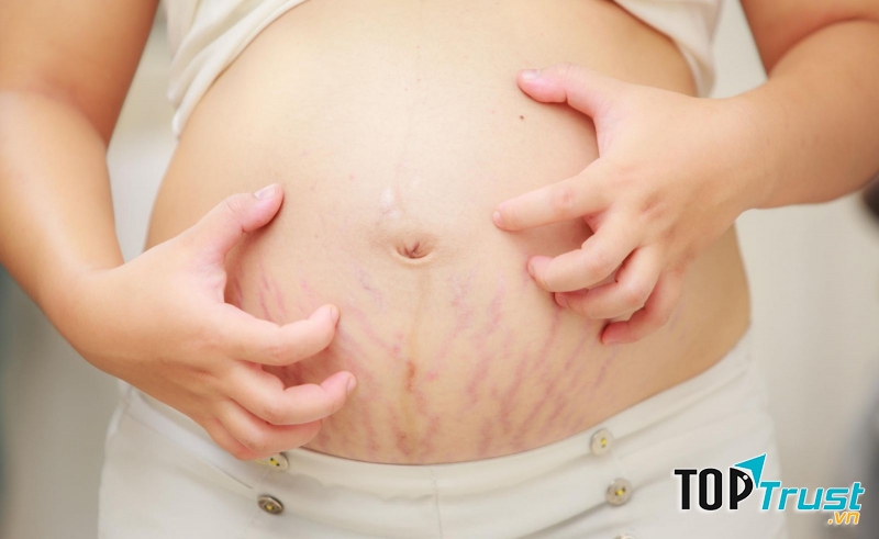Mẹ bầu có tiền sử da khô hoặc mắc chứng chàm bội nhiễm.